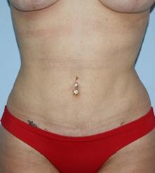 after Body Sculpting 6