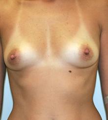 before Breast Augmentation 37