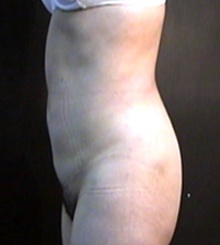 before Brazilian Butt Lift 3