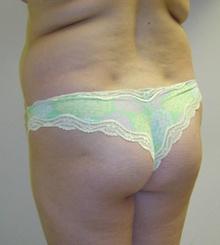 before Brazilian Butt Lift 13