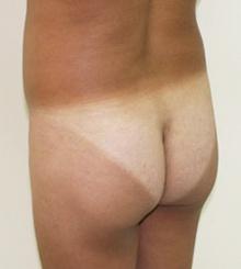before Brazilian Butt Lift 17