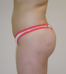 after Brazilian Butt Lift 1