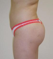 after Brazilian Butt Lift 1