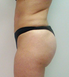after Brazilian Butt Lift 2