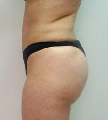 after Brazilian Butt Lift 2