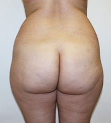 before Brazilian Butt Lift 24