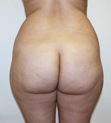 before Brazilian Butt Lift 24
