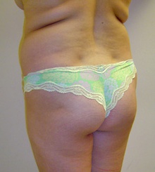 before Brazilian Butt Lift 1