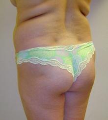 before Brazilian Butt Lift 1