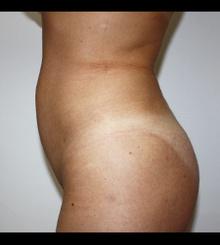 after Body Sculpting 13