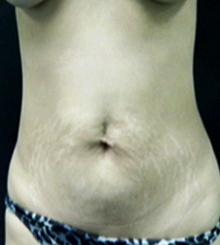 before Tummy Tuck 21