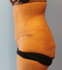 after Tummy Tuck 13