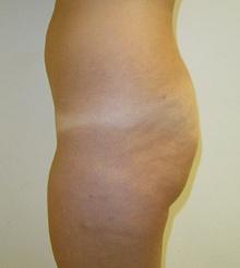 before Brazilian Butt Lift 16
