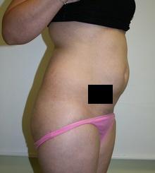 before Brazilian Butt Lift 11
