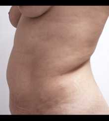 before Tummy Tuck 6