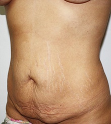 before Tummy Tuck 4