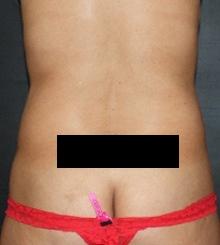 before Body Sculpting 7
