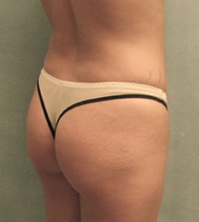 before Brazilian Butt Lift 15
