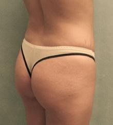 before Brazilian Butt Lift 15