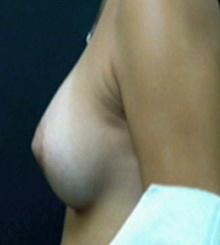 after Breast Augmentation 19