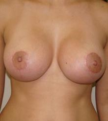 after Breast Lift 4