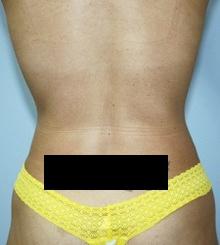 after Body Sculpting 7