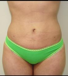 after Body Sculpting 3