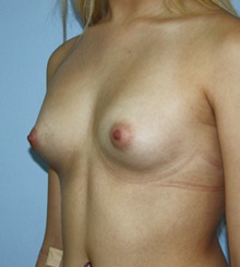 before Breast Augmentation 43
