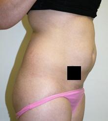 before Body Sculpting 2