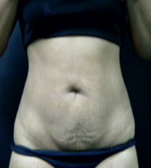 before Tummy Tuck 22