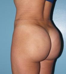 after Brazilian Butt Lift 20