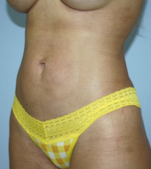 after Body Sculpting 7