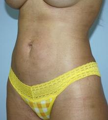 after Body Sculpting 7