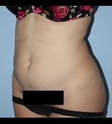 before Body Sculpting 6