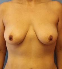 before Breast Lift 34