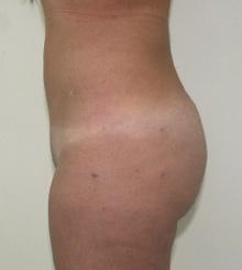 after Brazilian Butt Lift 16