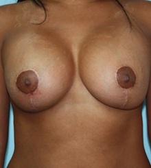 after Breast Lift 28