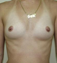 before Breast Augmentation 9