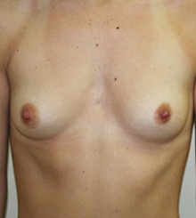 before Breast Augmentation 49