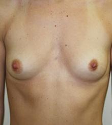 before Breast Augmentation 49