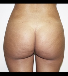 after Brazilian Butt Lift 9