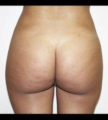 after Brazilian Butt Lift 9