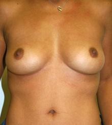 before Breast Augmentation 17