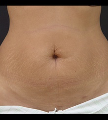 before Tummy Tuck 7
