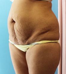 before Tummy Tuck 13