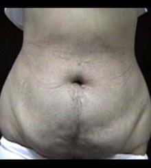 before Tummy Tuck 9