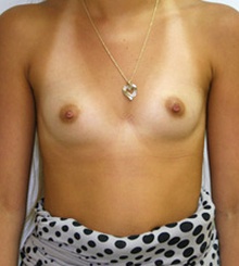 before Breast Augmentation 15