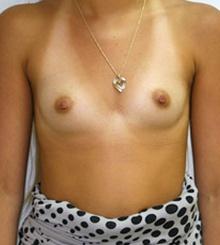 before Breast Augmentation 15