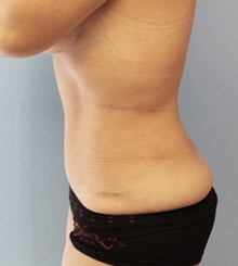 after Tummy Tuck 15
