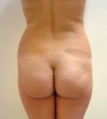 before Brazilian Butt Lift 8